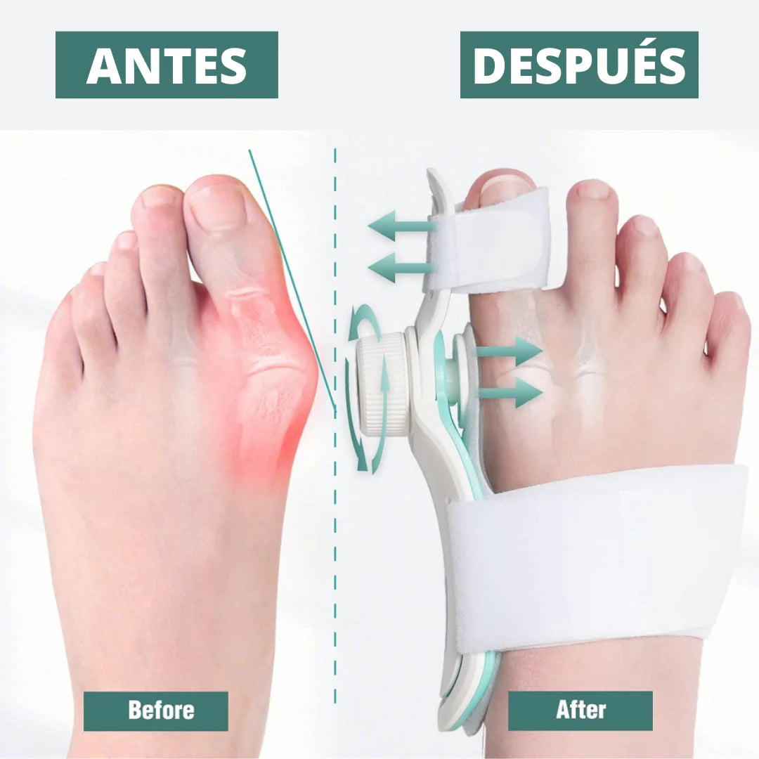 Corrector de Juanetes | OrthoStep Alivio y Corrección