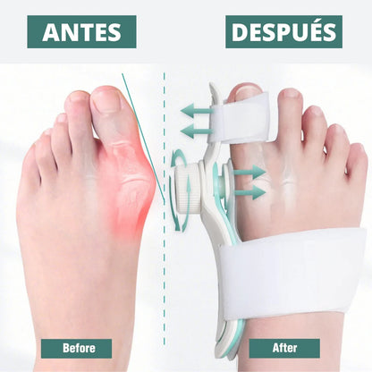 Corrector de Juanetes | OrthoStep Alivio y Corrección