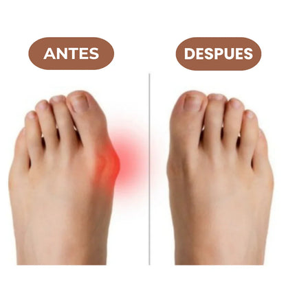 Corrector de Juanetes | OrthoStep Descanso para tus Pies