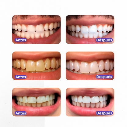 Sérum Blanqueador Dental | V34 BrightSmile Sonrisa Radiante